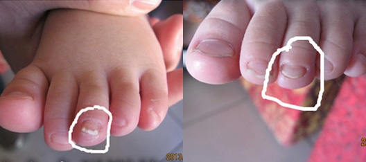 十六岁婴幼儿灰指甲修复效果图